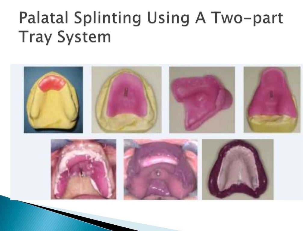 Impression techniques in complete denture
