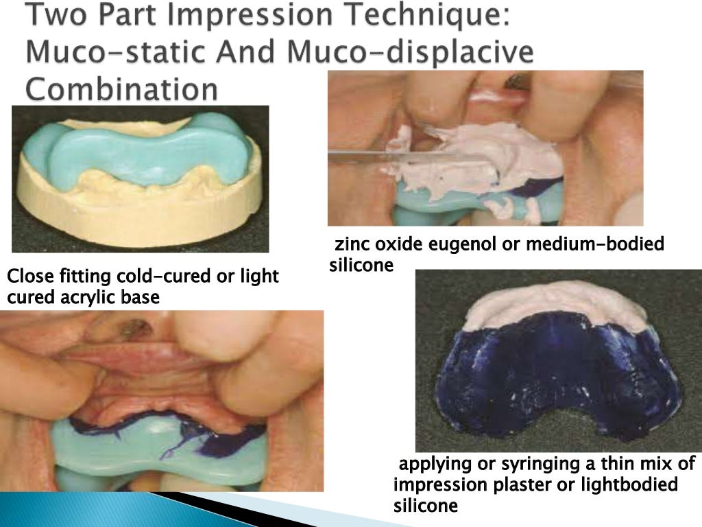 Impression techniques in complete denture