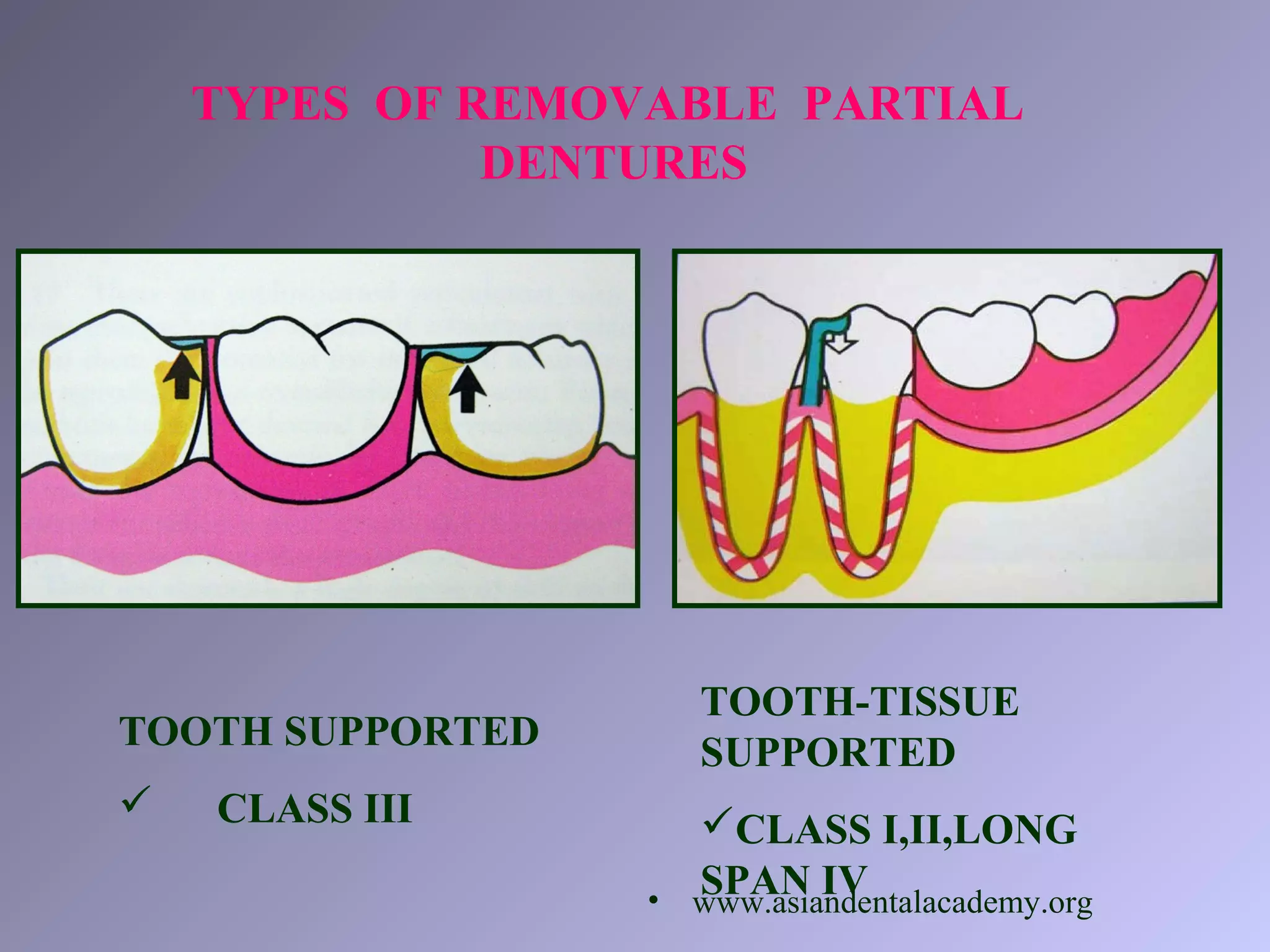 TYPES OF REMOVABLE PARTIAL
DENTURES
TOOTH SUPPORTED
 CLASS III
TOOTH-TISSUE
SUPPORTED
CLASS I,II,LONG
SPAN IV• www.asiandentalacademy.org
 