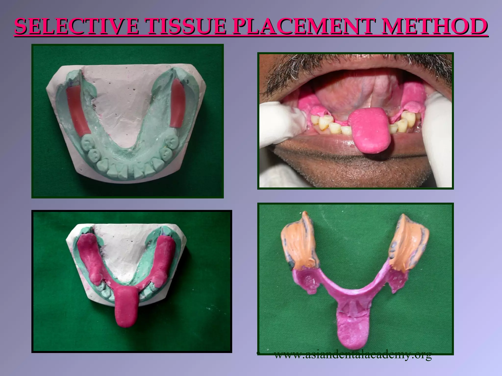 SELECTIVE TISSUE PLACEMENT METHODSELECTIVE TISSUE PLACEMENT METHOD
• www.asiandentalacademy.org
 
