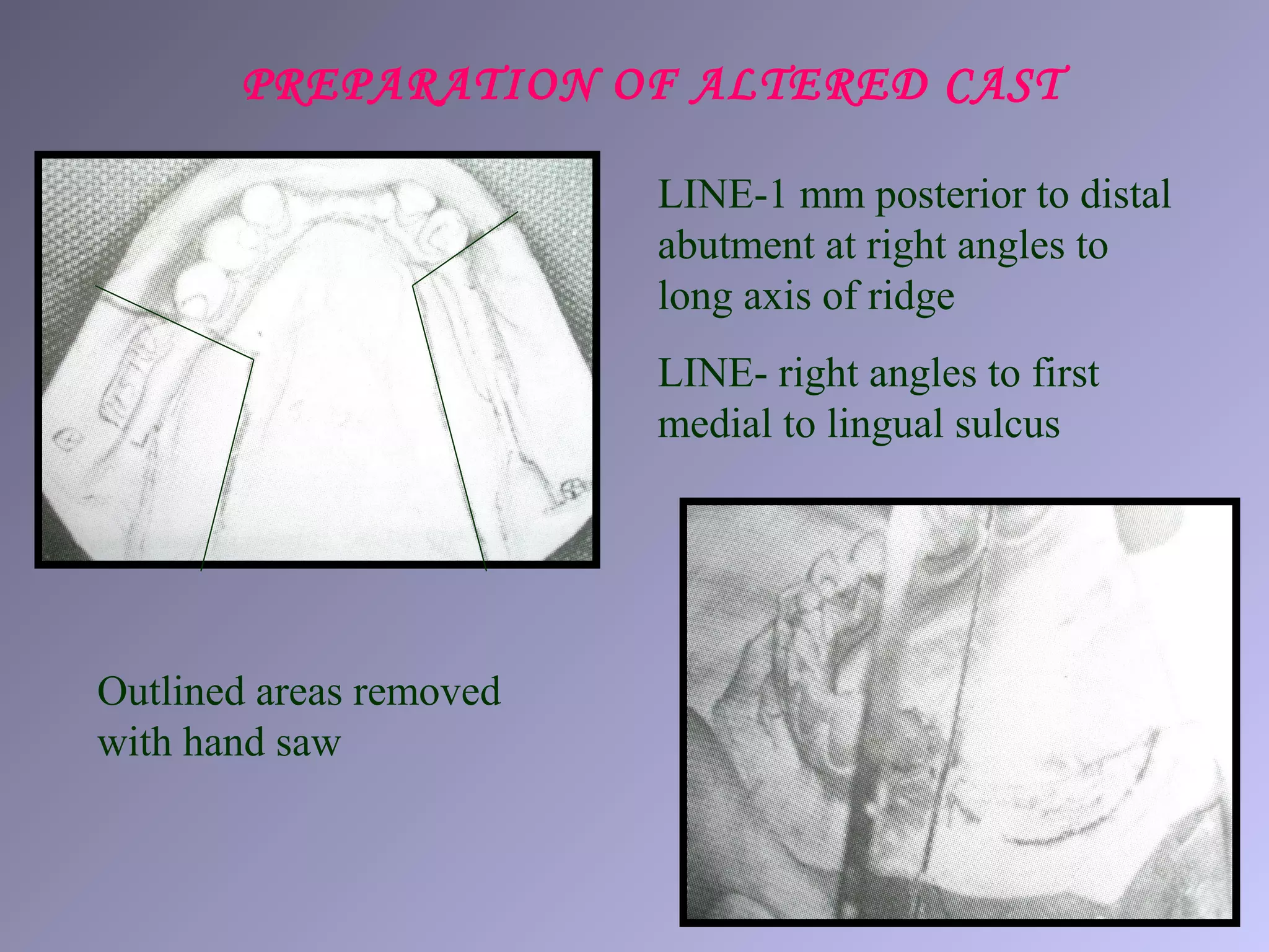 PREPARATION OF ALTERED CAST
LINE-1 mm posterior to distal
abutment at right angles to
long axis of ridge
LINE- right angles to first
medial to lingual sulcus
Outlined areas removed
with hand saw
 