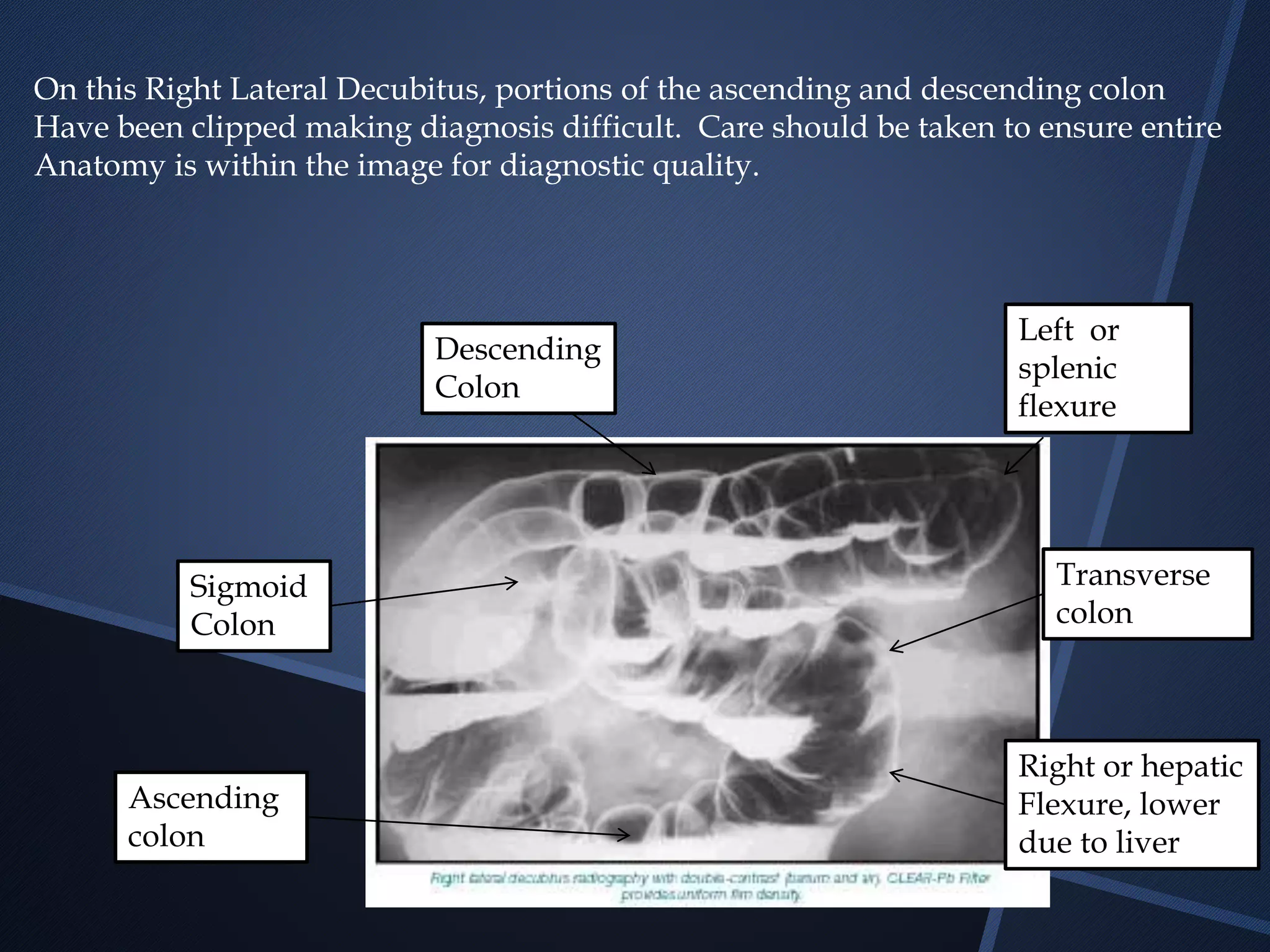 On this Right Lateral Decubitus, portions of the ascending and descending colon
Have been clipped making diagnosis difficult. Care should be taken to ensure entire
Anatomy is within the image for diagnostic quality.
Left or
splenic
flexure
Right or hepatic
Flexure, lower
due to liver
Sigmoid
Colon
Descending
Colon
Transverse
colon
Ascending
colon
 