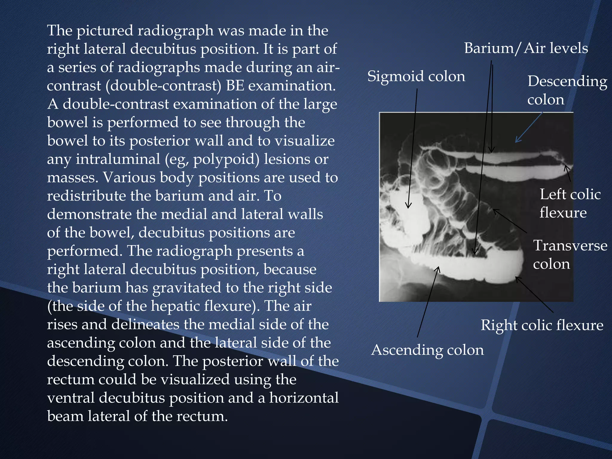 The pictured radiograph was made in the
right lateral decubitus position. It is part of
a series of radiographs made during an air-
contrast (double-contrast) BE examination.
A double-contrast examination of the large
bowel is performed to see through the
bowel to its posterior wall and to visualize
any intraluminal (eg, polypoid) lesions or
masses. Various body positions are used to
redistribute the barium and air. To
demonstrate the medial and lateral walls
of the bowel, decubitus positions are
performed. The radiograph presents a
right lateral decubitus position, because
the barium has gravitated to the right side
(the side of the hepatic flexure). The air
rises and delineates the medial side of the
ascending colon and the lateral side of the
descending colon. The posterior wall of the
rectum could be visualized using the
ventral decubitus position and a horizontal
beam lateral of the rectum.
Right colic flexure
Left colic
flexure
Ascending colon
Transverse
colon
Descending
colon
Sigmoid colon
Barium/Air levels
 