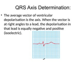 • The average vector of ventricular
depolarisation is the axis. When the vector is
at right angles to a lead, the depolarisation in
that lead is equally negative and positive
(isoelectric).
QRS Axis Determination:
 