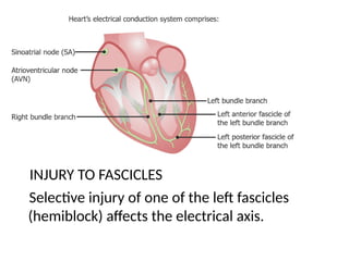 Conducting pathways
INJURY TO FASCICLES
Selective injury of one of the left fascicles
(hemiblock) affects the electrical axis.
 