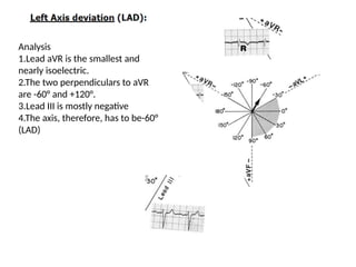 Analysis
1.Lead aVR is the smallest and
nearly isoelectric.
2.The two perpendiculars to aVR
are -60° and +120°.
3.Lead III is mostly negative
4.The axis, therefore, has to be-60°
(LAD)
 