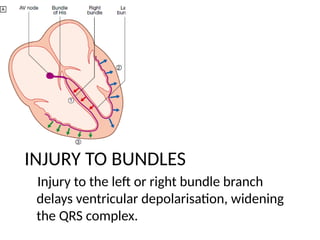 INJURY TO BUNDLES
Injury to the left or right bundle branch
delays ventricular depolarisation, widening
the QRS complex.
 