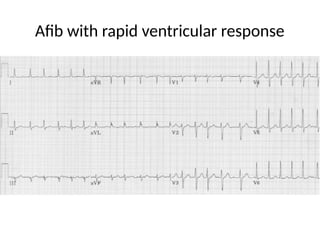 Afib with rapid ventricular response
 
