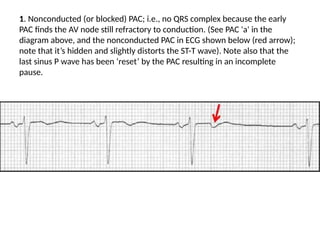 1. Nonconducted (or blocked) PAC; i.e., no QRS complex because the early
PAC finds the AV node still refractory to conduction. (See PAC 'a' in the
diagram above, and the nonconducted PAC in ECG shown below (red arrow);
note that it’s hidden and slightly distorts the ST-T wave). Note also that the
last sinus P wave has been ‘reset’ by the PAC resulting in an incomplete
pause.
 