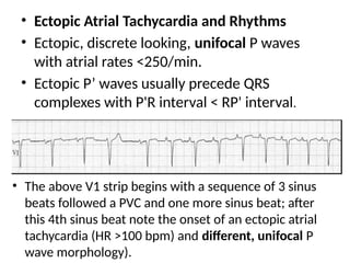 • The above V1 strip begins with a sequence of 3 sinus
beats followed a PVC and one more sinus beat; after
this 4th sinus beat note the onset of an ectopic atrial
tachycardia (HR >100 bpm) and different, unifocal P
wave morphology).
• Ectopic Atrial Tachycardia and Rhythms
• Ectopic, discrete looking, unifocal P waves
with atrial rates <250/min.
• Ectopic P’ waves usually precede QRS
complexes with P'R interval < RP' interval.
 
