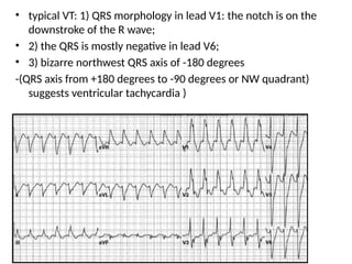 • typical VT: 1) QRS morphology in lead V1: the notch is on the
downstroke of the R wave;
• 2) the QRS is mostly negative in lead V6;
• 3) bizarre northwest QRS axis of -180 degrees
-(QRS axis from +180 degrees to -90 degrees or NW quadrant)
suggests ventricular tachycardia )
 