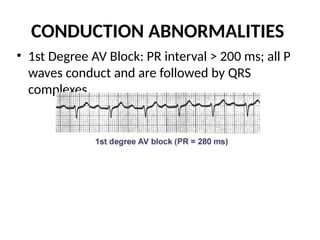 CONDUCTION ABNORMALITIES
• 1st Degree AV Block: PR interval > 200 ms; all P
waves conduct and are followed by QRS
complexes.
 