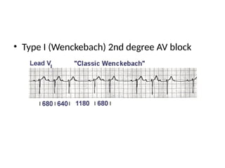 • Type I (Wenckebach) 2nd degree AV block
 