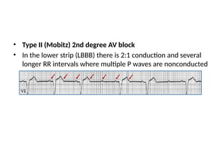 • Type II (Mobitz) 2nd degree AV block
• In the lower strip (LBBB) there is 2:1 conduction and several
longer RR intervals where multiple P waves are nonconducted
 