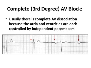 Complete (3rd Degree) AV Block:
• Usually there is complete AV dissociation
because the atria and ventricles are each
controlled by independent pacemakers
 