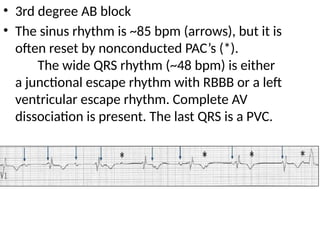 • 3rd degree AB block
• The sinus rhythm is ~85 bpm (arrows), but it is
often reset by nonconducted PAC’s (*).
The wide QRS rhythm (~48 bpm) is either
a junctional escape rhythm with RBBB or a left
ventricular escape rhythm. Complete AV
dissociation is present. The last QRS is a PVC.
 