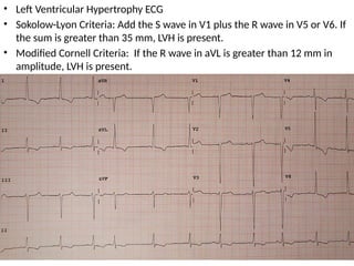 • Left Ventricular Hypertrophy ECG
• Sokolow-Lyon Criteria: Add the S wave in V1 plus the R wave in V5 or V6. If
the sum is greater than 35 mm, LVH is present.
• Modified Cornell Criteria: If the R wave in aVL is greater than 12 mm in
amplitude, LVH is present.
 
