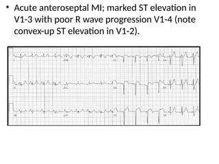 • Acute anteroseptal MI; marked ST elevation in
V1-3 with poor R wave progression V1-4 (note
convex-up ST elevation in V1-2).
 