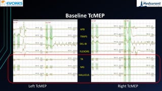 Improved transcranial motor evoked potentials after craniovertebral ...