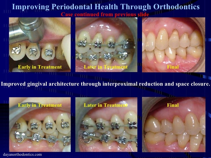 Improving Gum Tissue Health Through Orthodontics