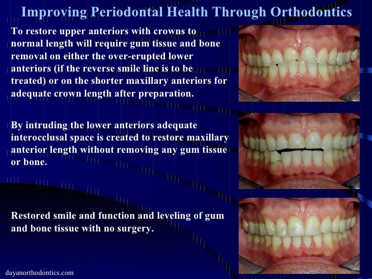 Improving Gum Tissue Health Through Orthodontics