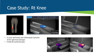 Pfd Rt Knee Improving Plan Quality & Safety Using Surface Guided Planning and Dose ...
