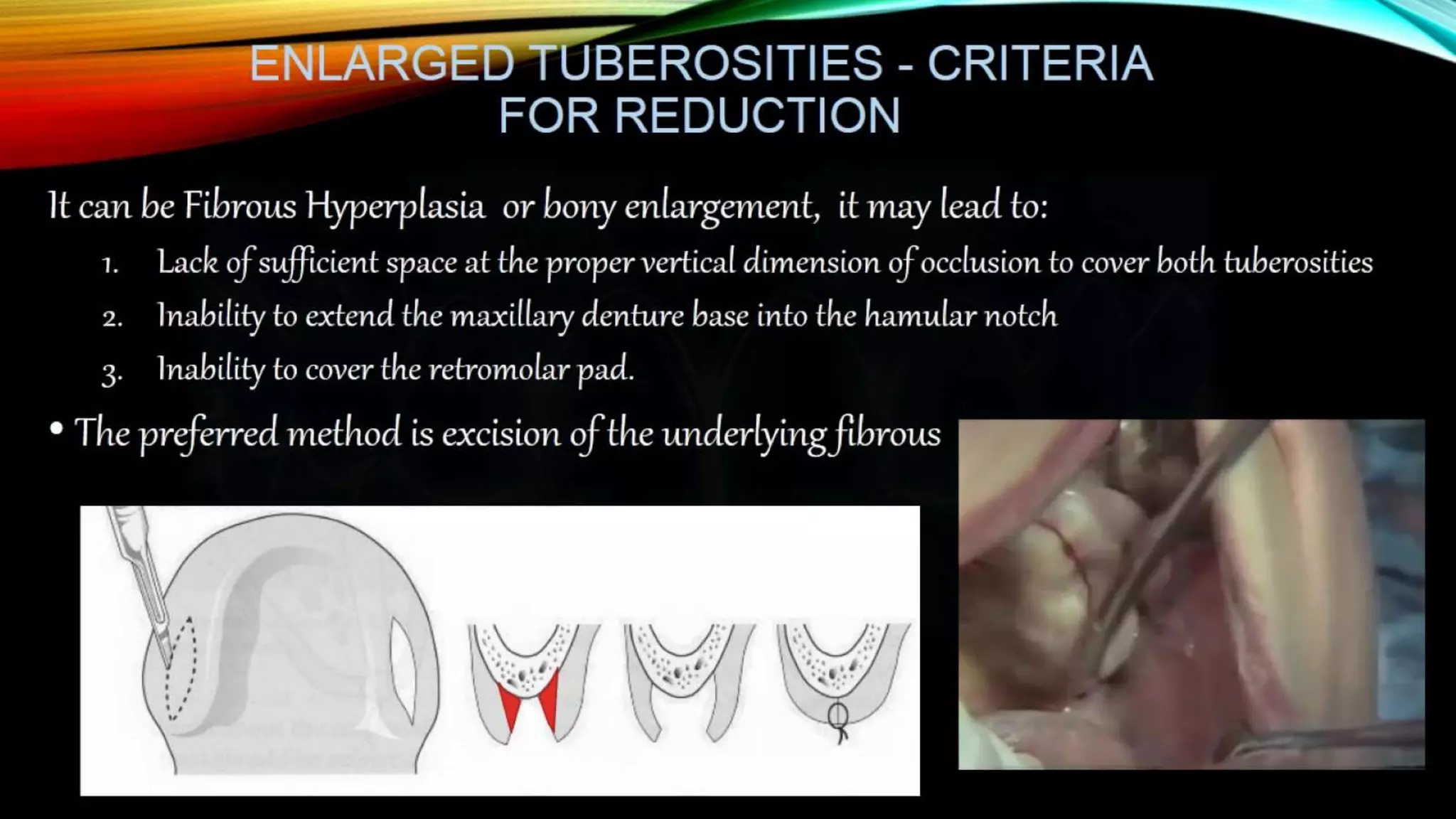 Improving the complete denture  foundation