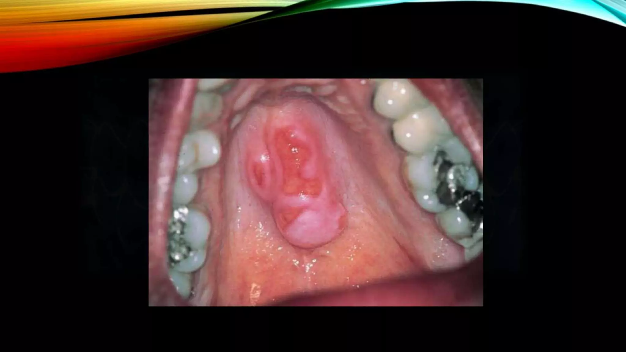 Improving the complete denture  foundation