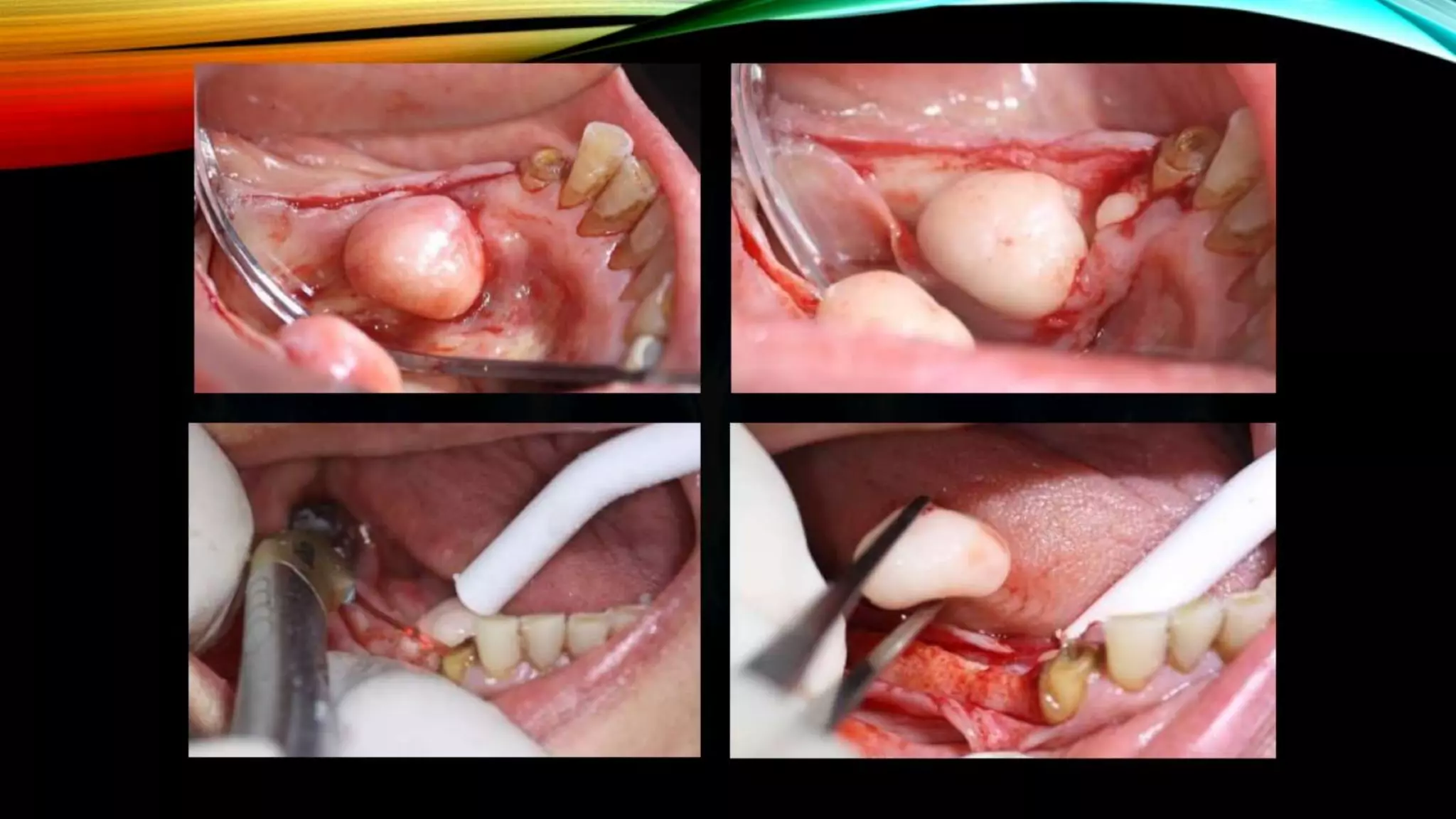 Improving the complete denture  foundation