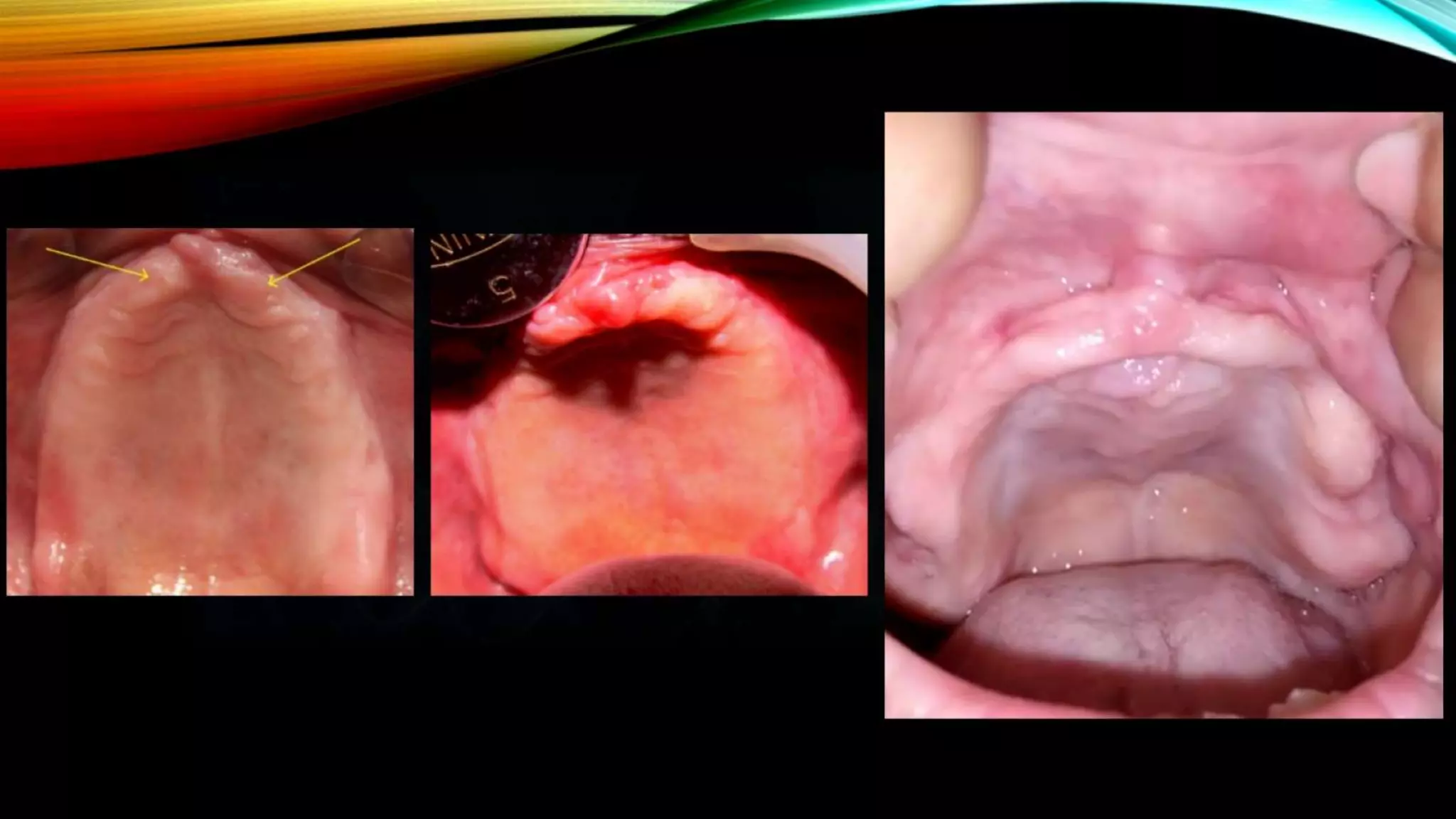 Improving the complete denture  foundation