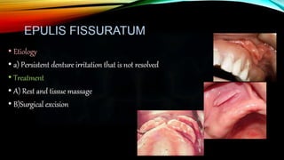 Improving the complete denture  foundation