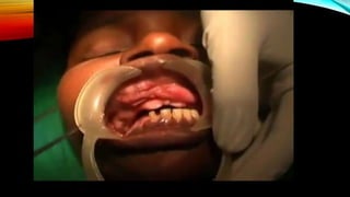 Improving the complete denture  foundation