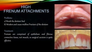 Improving the complete denture  foundation