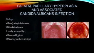 Improving the complete denture  foundation