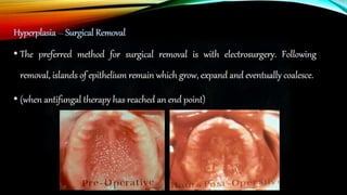 Improving the complete denture  foundation