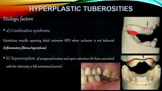 Improving the complete denture  foundation