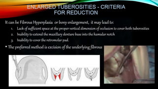 Improving the complete denture  foundation