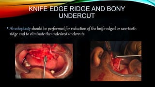 Improving the complete denture  foundation