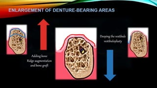Improving the complete denture  foundation