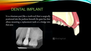 Improving the complete denture  foundation
