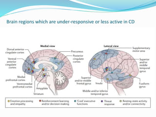Brain regions which are under-responsive or less active in CD
 
