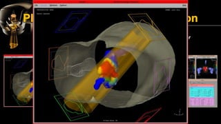 Intensity Modulated Radiation Therapy (IMRT) | PDF