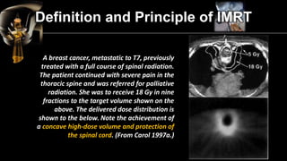 Conventional Radiotherapy 
FIELD 3 
Conventional Radiotherapy vs. IMRT  
