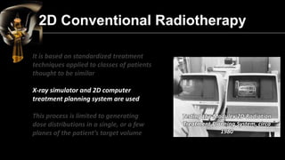 2D Conventional Radiotherapy It is based on standardized treatment techniques applied to classes of patients thought to be...