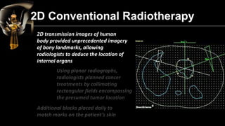 2D Conventional Radiotherapy 
2D transmission images of human body provided unprecedented imagery of bony landmarks, allow...