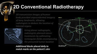 3D Conformal Radiotherapy 
It allows to increase the doses of radiation delivered to the tumor without increasing damage t...