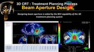 3D CRT : Treatment Planning Process 
Combination of multileaf collimators and independent jaws provides almost unlimited c...