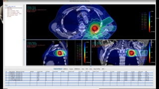 3D CRT : Treatment Planning Process 
An optimal plan should deliver tumoricidal dose to the entire tumor and spare all the...