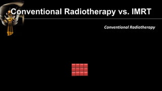 IMRT 
Conventional Radiotherapy vs. IMRT  