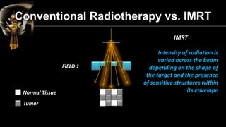 Tumor and Normal tissues are irradiated with UNIFORM DOSE..! 
Conventional Radiotherapy 
IMRT 
Tumor and Normal tissues ar...